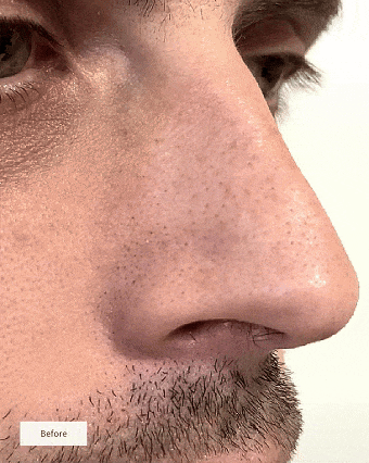 Patches Nez Purifiants