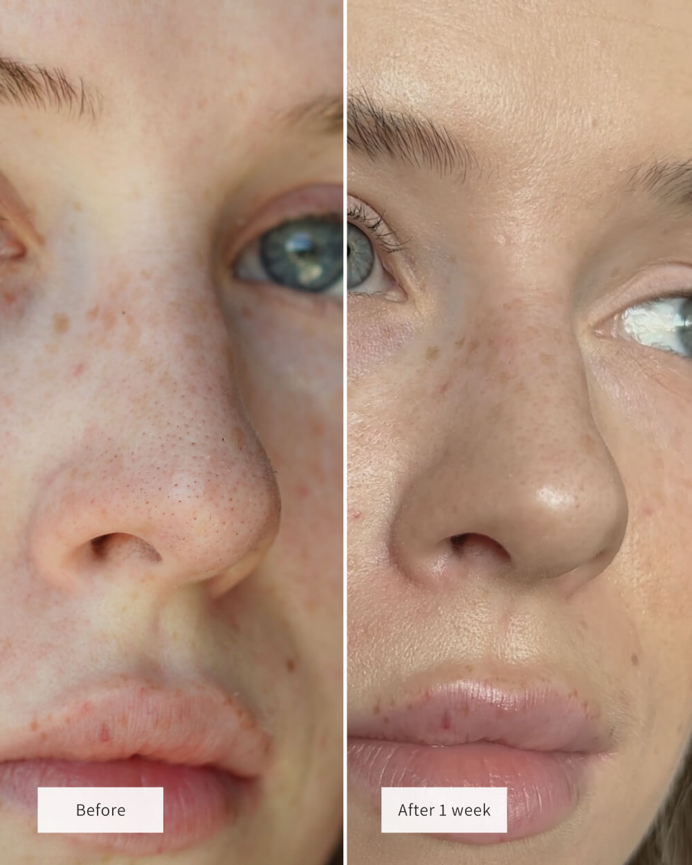 Patches Nez Purifiants