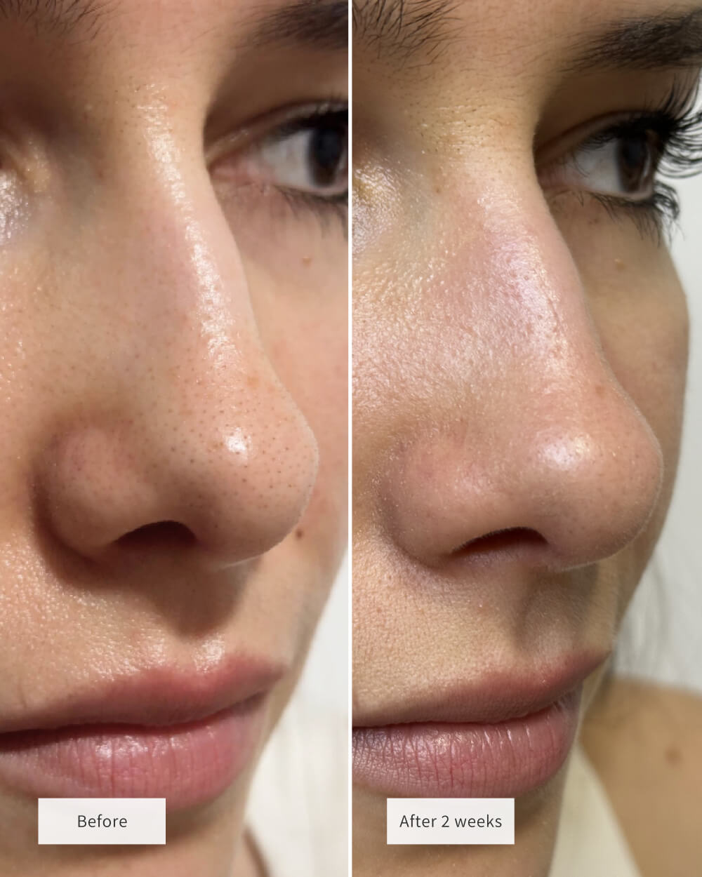 Patches Nez Purifiants